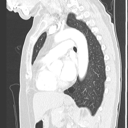 Amyloidosis - bronchial and diffuse nodular pulmonary involvement (Radiopaedia 60156-67745 Sagittal lung window 52).jpg