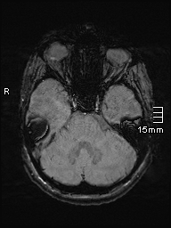 Amyotrophic lateral sclerosis (Radiopaedia 70821-81017 Axial SWI 11).jpg