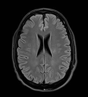 File:Amyotrophic lateral sclerosis (Radiopaedia 87352-103658 Axial FLAIR 19).jpg