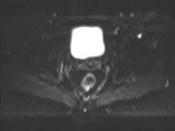 File:Anal adenocarcinoma - tumor regression grade 1 (Radiopaedia 31358-32100 Axial DWI 18).jpg