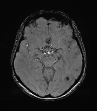 Anaplastic astrocytoma (Radiopaedia 86943-103160 Axial SWI 40).png