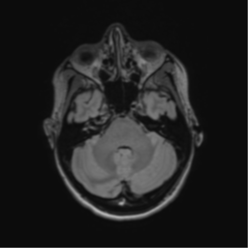 File:Anaplastic astrocytoma IDH mutant (Radiopaedia 50046-55341 Axial FLAIR 14).png