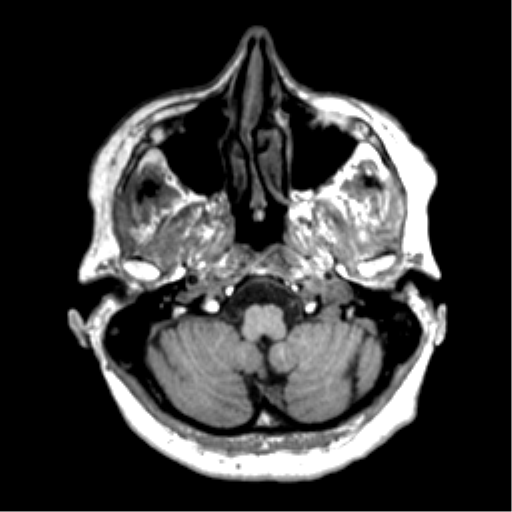 Anaplastic astrocytoma IDH wild-type (pseudoprogression) (Radiopaedia 42209-45277 Axial T1 19).png