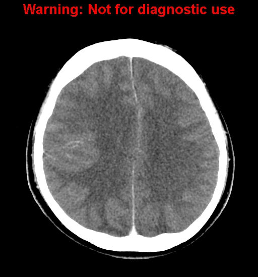 File:Anaplastic ganglioglioma (Radiopaedia 44921-48815 B 20).jpg