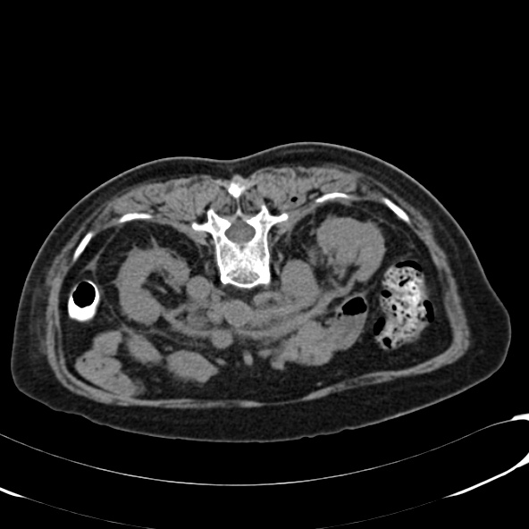 File:Anaplastic lymphoma - with CT biopsy (Radiopaedia 21643-21603 Axial non-contrast 3).jpg
