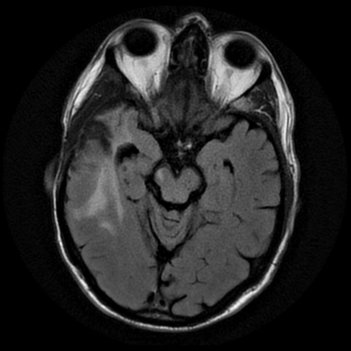 File:Anaplastic meningioma with recurrence (Radiopaedia 34452-35790 Axial T2 FLAIR 8).png