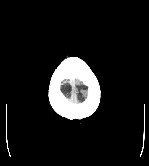 Anaplastic oligodendroglioma (Radiopaedia 79571-92753 Axial non-contrast 50).jpg