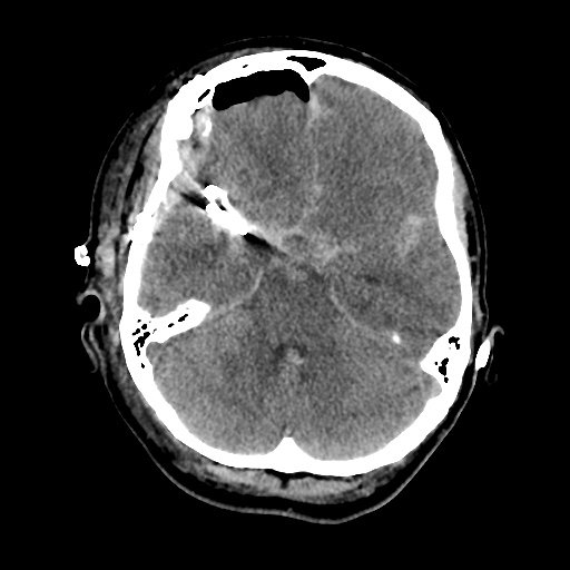 Aneursym related subarachnoid hemorrhage with hydrocephalus (Radiopaedia 45105-49085 Axial non-contrast 15).jpg