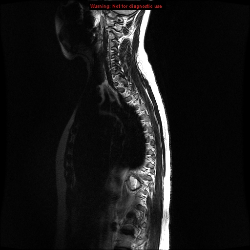 File:Aneurysmal bone cyst (Radiopaedia 9419-10103 G 10).jpg