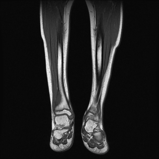 File:Aneurysmal bone cyst - tibia (Radiopaedia 22343-22367 Coronal T1 7).jpg