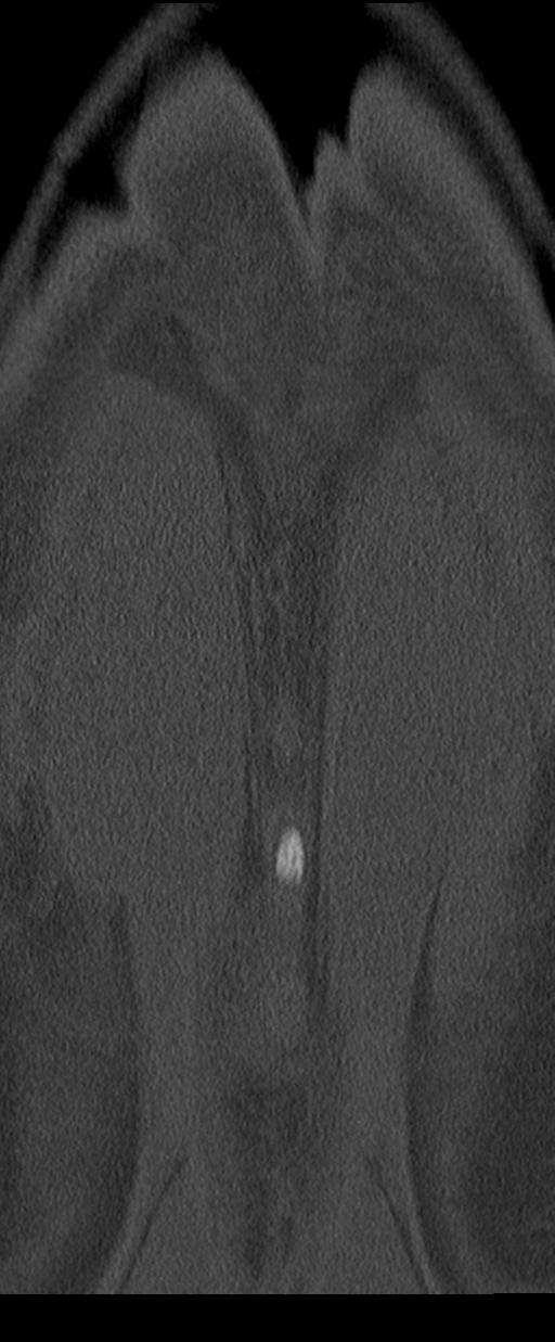 Aneurysmal bone cyst T11 (Radiopaedia 29294-29721 Coronal bone window 67).jpg