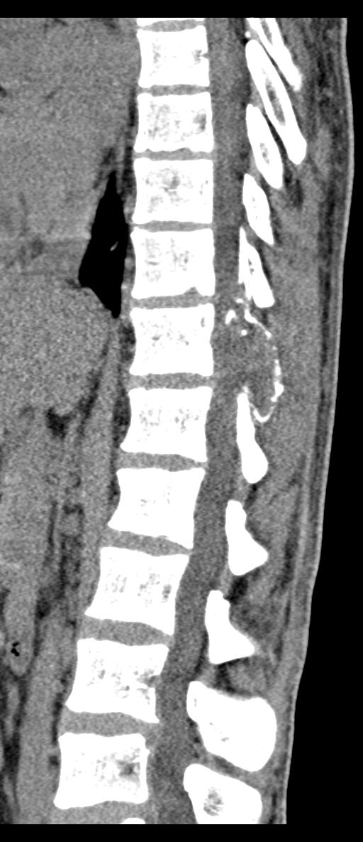 Aneurysmal bone cyst T11 (Radiopaedia 29294-29721 E 43).jpg