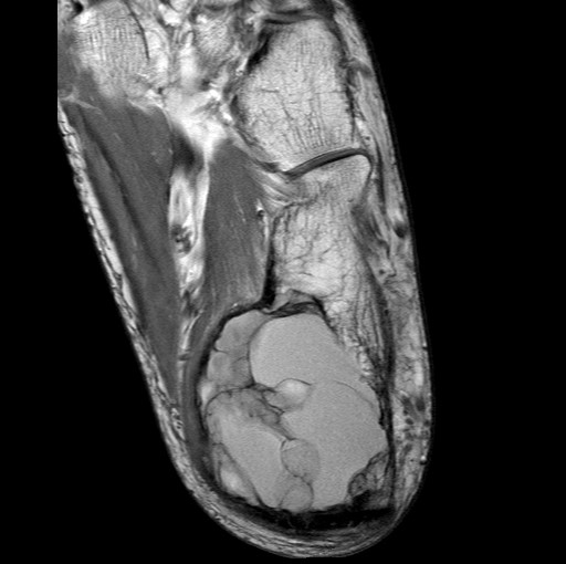 File:Aneurysmal bone cyst of the calcaneus (Radiopaedia 60669-68420 Axial PD 8).jpg