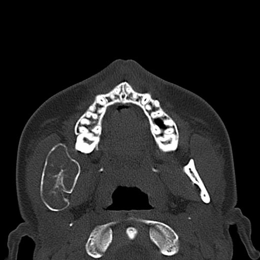 File:Aneurysmal bone cyst of the mandible (Radiopaedia 43280-46601 Axial bone window 49).jpg