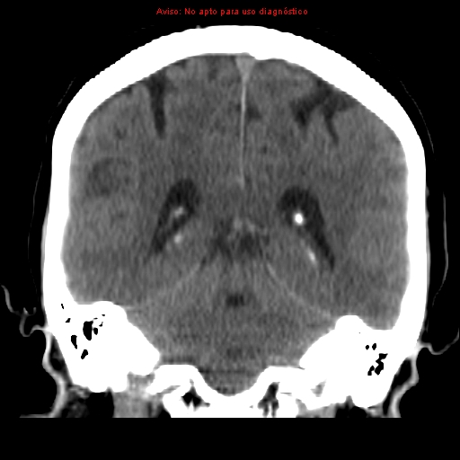 File:Aneurysmal subarachnoid hemorrhage (Radiopaedia 24740-24997 Coronal non-contrast 31).jpg