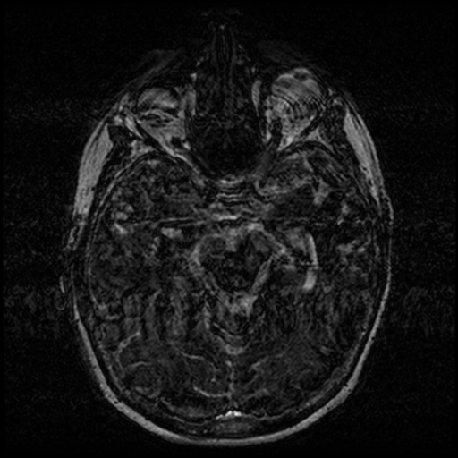 Angioinvasive aspergillosis in the pituitary fossa (Radiopaedia 39676-42010 Ax 3D FIESTA VOLUME 63).png