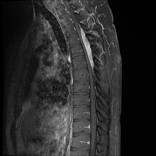 File:Angiolipoma - thoracic spine (Radiopaedia 28242-28479 E 8).jpg