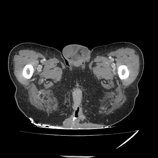 Anorectal carcinoma (Radiopaedia 44413-48064 A 66).jpg