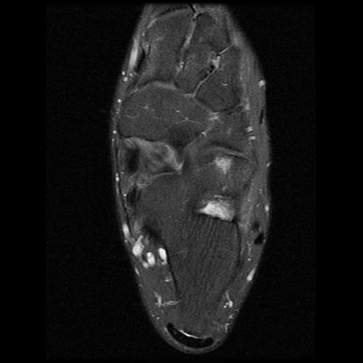 File:Anterior calcaneal process fracture (Radiopaedia 74654-85611 Axial PD fat sat 16).jpg