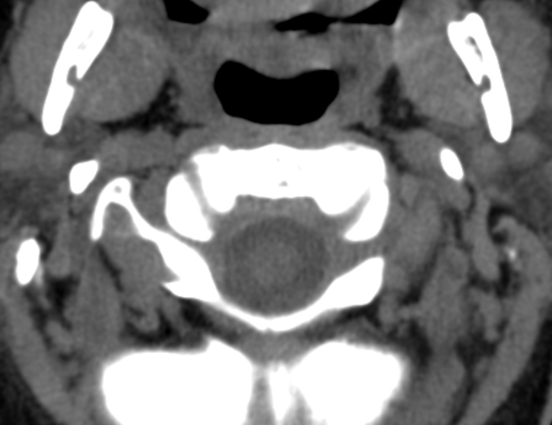 Anterior cervical postdiscectomy arthrodesis (Radiopaedia 32678-33646 Axial non-contrast 15).jpg
