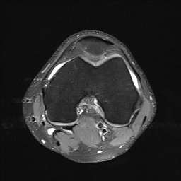 File:Anterior cruciate ligament full thickness tear (Radiopaedia 66268-75467 Axial PD fat sat 13).jpg