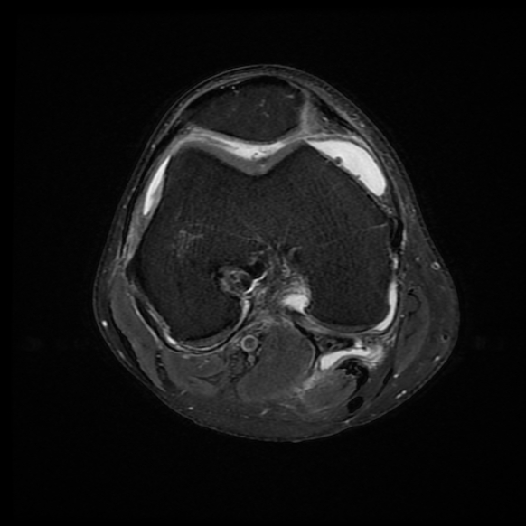 File:Anterior cruciate ligament graft tear and bucket-handle tear of medial meniscus (Radiopaedia 75867-87255 Axial PD fat sat 13).jpg