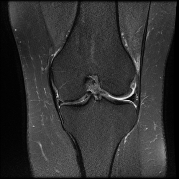 File:Anterior cruciate ligament tear, Wrisberg rip and bucket-handle tear of medial meniscus (Radiopaedia 75872-87266 Coronal PD fat sat 15).jpg