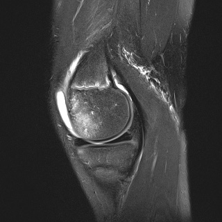 File:Anterior cruciate ligament tear - pediatric (Radiopaedia 62152-70260 Sagittal PD fat sat 11).jpg