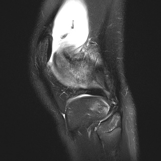 File:Anterior cruciate ligament tear - pediatric (Radiopaedia 62152-70260 Sagittal PD fat sat 30).jpg