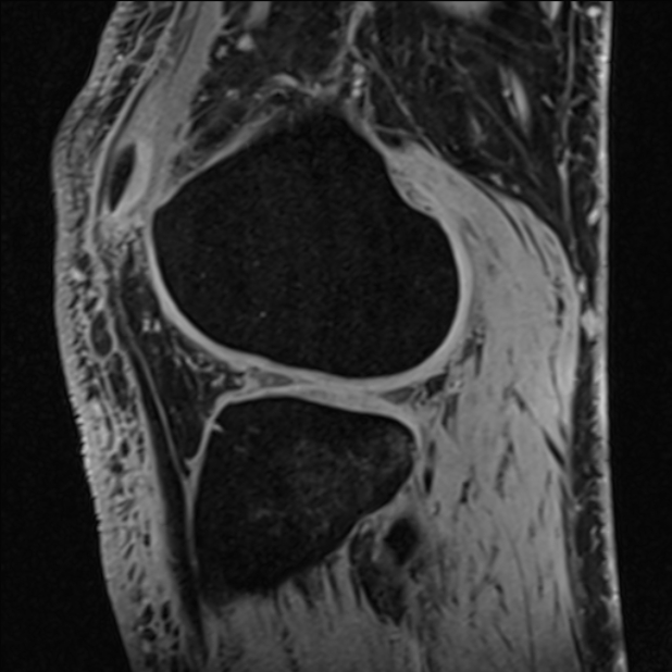 Anterior cruciate ligament tear - ramp lesion (Radiopaedia 71883-82322 Sagittal T1 vibe 43).jpg