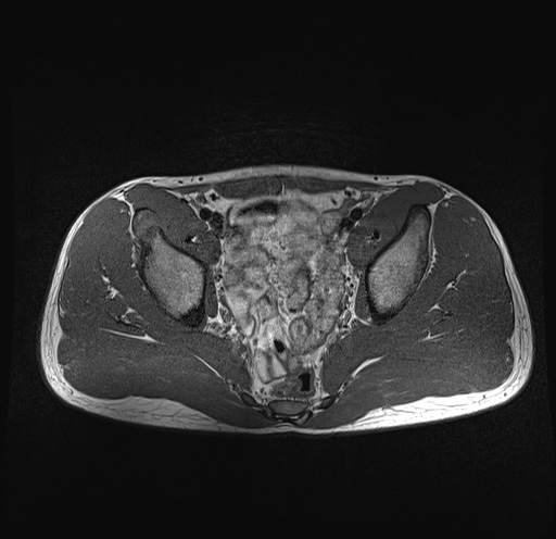File:Anterior inferior iliac spine avulsion fracture (Radiopaedia 81312-95000 Axial T1 24).jpg