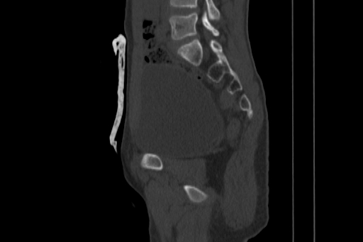 Anterior inferior iliac spine avulsion injury (Radiopaedia 88666-105376 Sagittal bone window 44).jpg