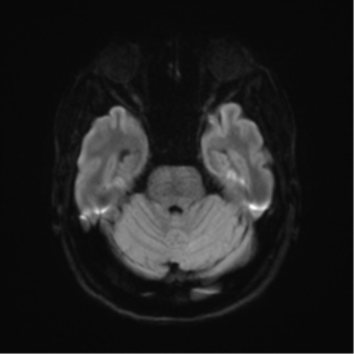 File:Anterior temporal lobe perivascular space (Radiopaedia 40946-43650 Axial DWI 35).png