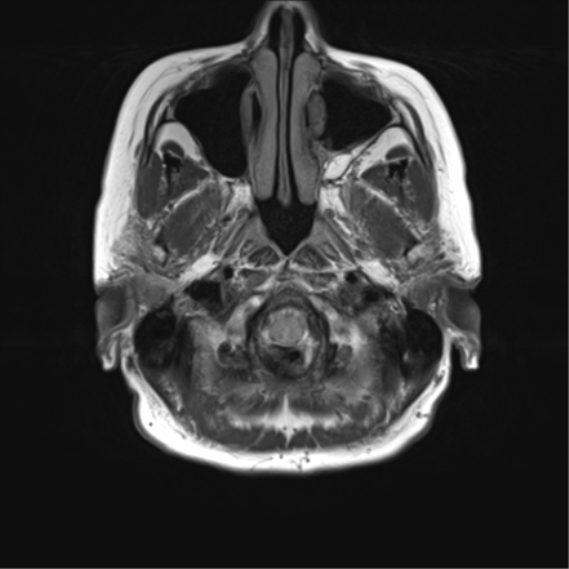 File:Anterior temporal pole cysts (Radiopaedia 46629-51102 Axial FLAIR 2).png