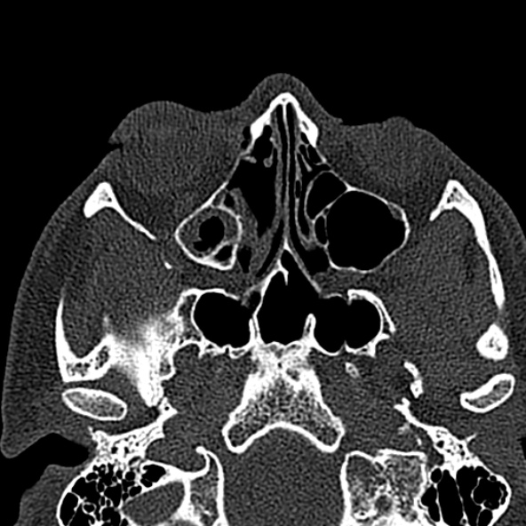 Antrochoanal polyp (Radiopaedia 30002-30554 Axial bone window 32).jpg