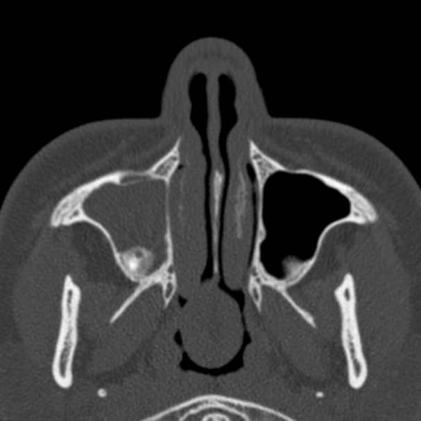 Antrochoanal polyp (Radiopaedia 33984-35202 Axial bone window 16).jpg