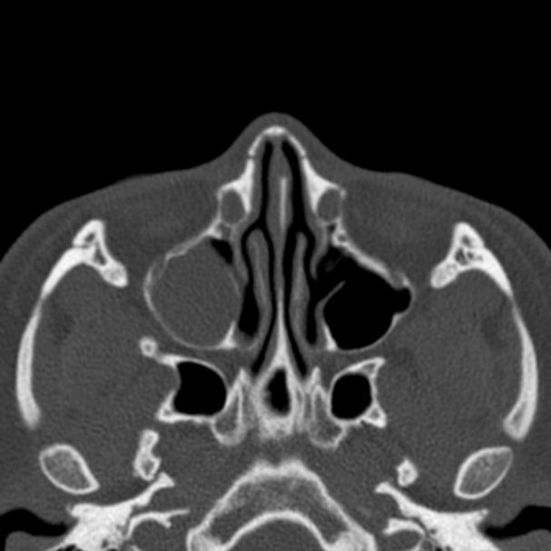 Antrochoanal polyp (Radiopaedia 33984-35202 Axial bone window 36).jpg