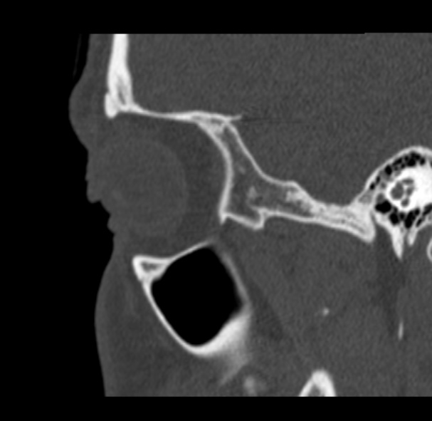 Antrochoanal polyp (Radiopaedia 33984-35202 Sagittal bone window 71).jpg