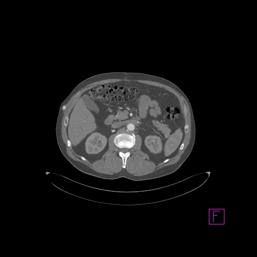 Aortectomy and axillary-bifemoral bypass (Radiopaedia 28303-28545 C 1).jpg
