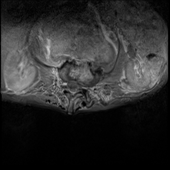 File:Aortic aneurysm with spinal destruction (Radiopaedia 42301-45409 Axial T1 fat sat 11).jpg