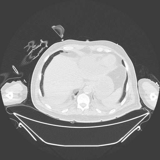 Aortic arch aneurysm (Radiopaedia 84109-99365 Axial lung window 234).jpg