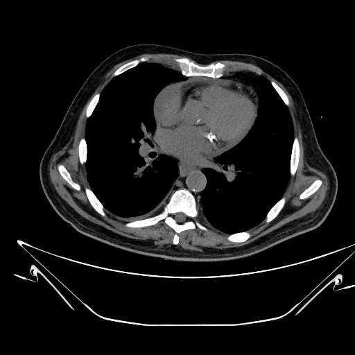 Aortic arch aneurysm (Radiopaedia 84109-99365 Axial non-contrast 156).jpg