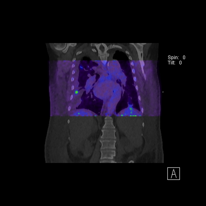 Aortic arch graft infection (FDG PET-CT) (Radiopaedia 71975-82438 D 57).jpg