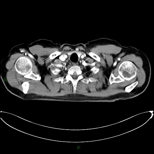 Aortic arch origin of left vertebral artery (Radiopaedia 46327-50737 Axial post contrast 9).jpg