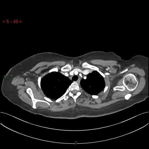 Aortic arch origin of left vertebral artery (Radiopaedia 51520-57286 A 48).jpg