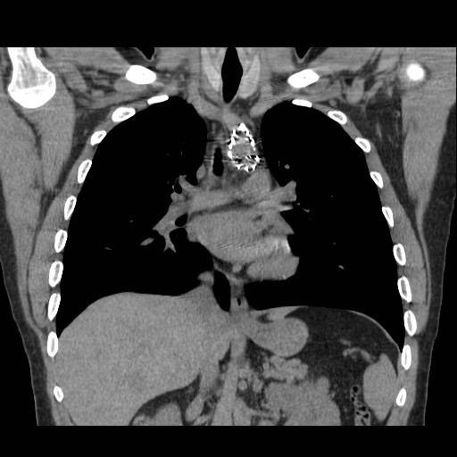File:Aortic arch stent (Radiopaedia 30030-30595 Coronal non-contrast 11).jpg