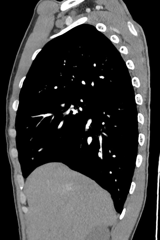 Aortic coarctation with aneurysm (Radiopaedia 74818-85828 B 46).jpg