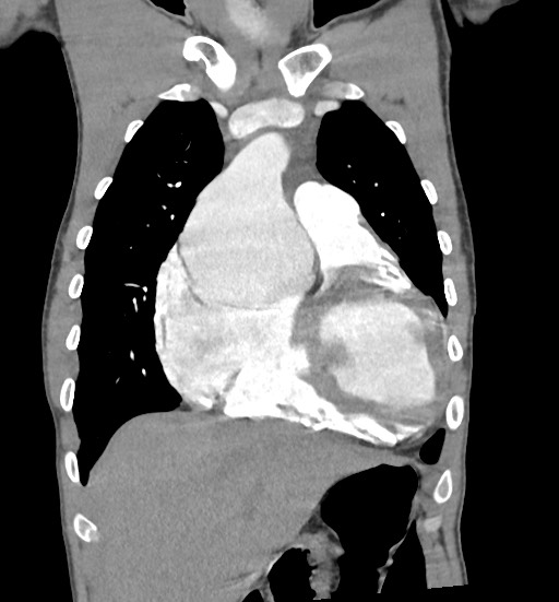 Aortic coarctation with aneurysm (Radiopaedia 74818-85828 C 34).jpg