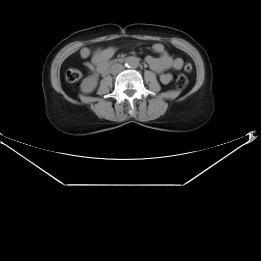 Aortic dissection (Radiopaedia 25350-25604 B 53).jpg