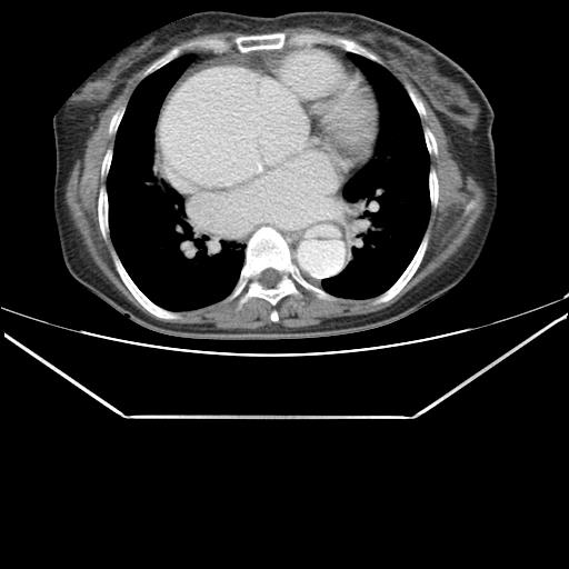 File:Aortic dissection (Radiopaedia 25350-25604 C 28).jpg